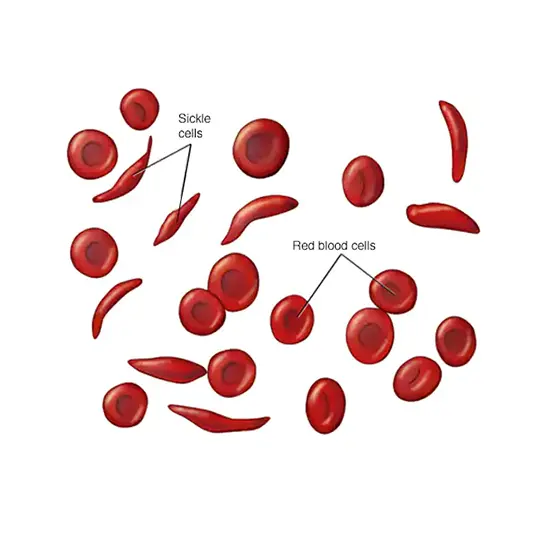 Sickle Cell Disease: What It Is, Causes & Symptoms